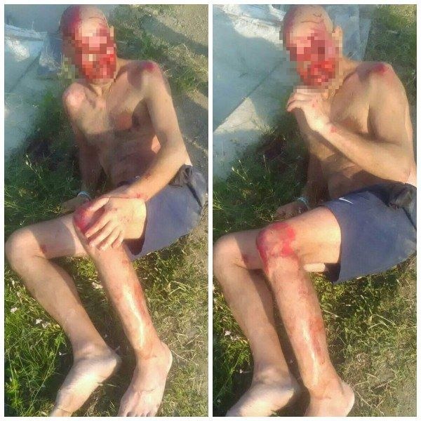 Мъж от Калояново е блъснатият край Слънчев бряг, състоянието му е критично