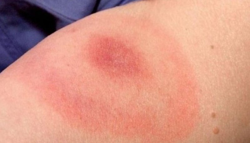 Нов случай на заразен с лаймска болест у нас, кърлежите се активираха