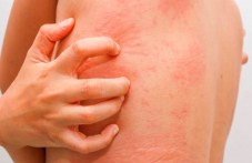 atopichniiat-dermatit-ima-bezbroi-litsa-631.jpg