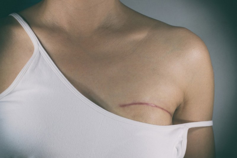 Ракът на гърдата атакува все по-млади жени у нас