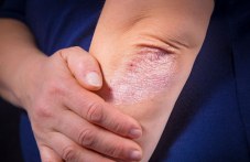 psoriazisat-poraziava-stavite-i-sartseto-980.jpeg