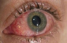 imate-alergichen-konyuktivit-ne-se-913.jpg