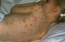 vazmozhen-e-bum-morbili-stranata-943.jpg