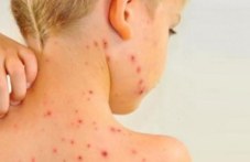 ima-risk-epidemiia-morbili-u-nas-320.jpg