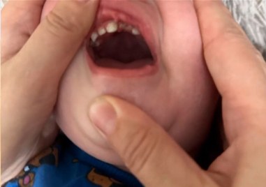Дете е с разбита уста, счупен зъб и синини в Пловдив