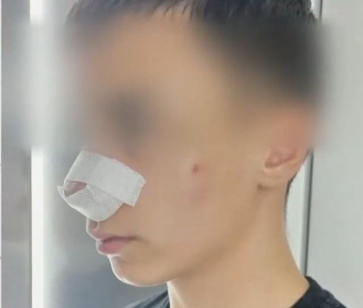 Нов случай на насилие между деца: Момче е със счупен нос и комоцио