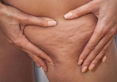 Целулитът не е просто козметичен дефект, а сигнал от тялото