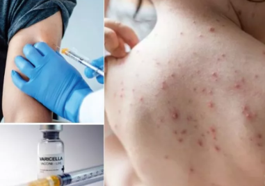 Ваксинирането срещу варицела става задължително от юли