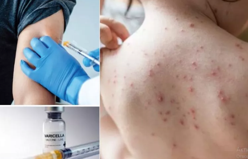 Ваксинирането срещу варицела става задължително от юли