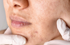 Напитките, които съсипват кожата ни