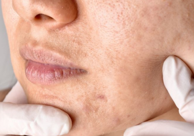 Напитките, които съсипват кожата ни