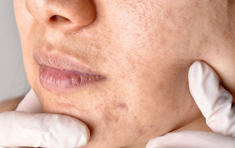 Напитките, които съсипват кожата ни