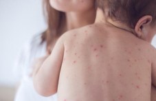 Почти троен скок на случаите на варицела в Пловдив след празниците