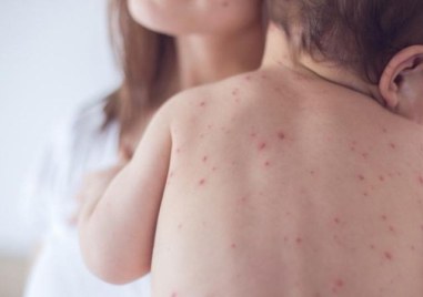 Почти троен скок на случаите на варицела в Пловдив след празниците