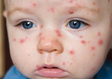 Пловдивски лекар обясни защо ваксината срещу варицела е важна