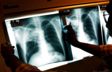 24 март - Световен ден за борба с туберкулозата