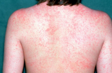 Морбили се завърна заради отслабения колективен имунитет