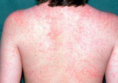 Морбили се завърна заради отслабения колективен имунитет