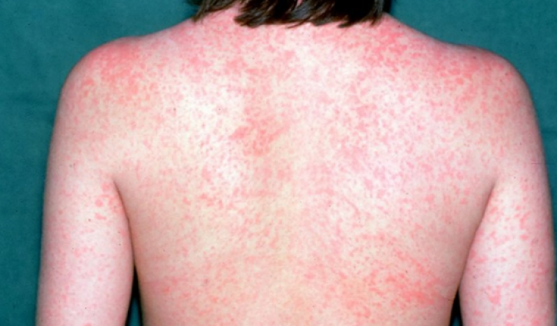 Морбили се завърна заради отслабения колективен имунитет