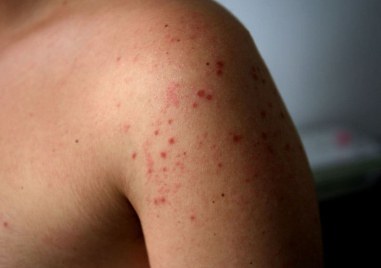 Нови случаи на морбили у нас