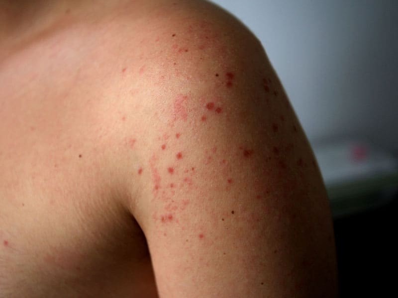 Нови случаи на морбили у нас