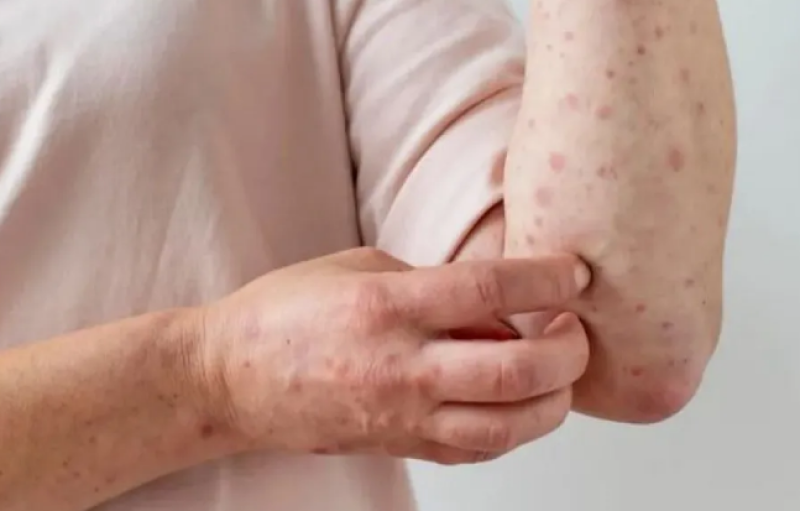 149 са вече случаите на морбили у нас