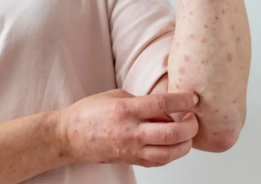 149 са вече случаите на морбили у нас