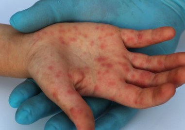 153 са вече случаите на морбили в страната