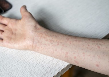 Нови случаи на морбили у нас