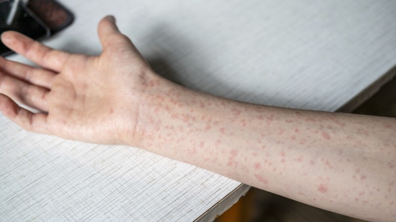 Нови случаи на морбили у нас