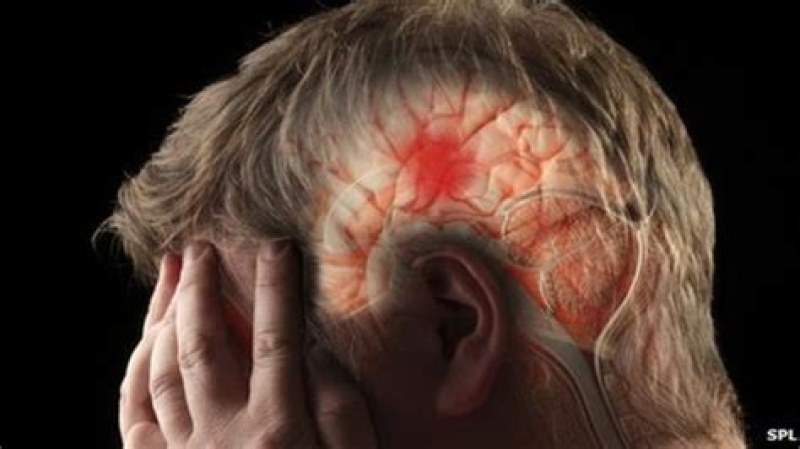 Тревожен ръст на инсултите сред млади хора под 35 години